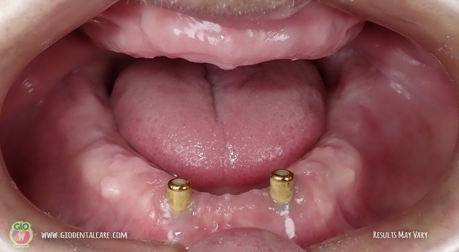 gio-dental-implants-1